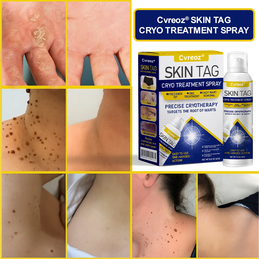 🎉SPECIAL OFFER: 60% OFF This Week Only!🔥 Skin Tag Cryo Treatment Spray