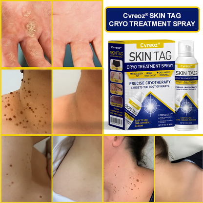🎉SPECIAL OFFER: 60% OFF This Week Only!🔥 Skin Tag Cryo Treatment Spray
