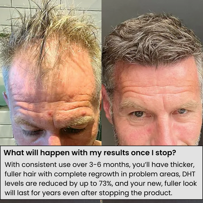 Ascendrtop™ Hair Regrowth System