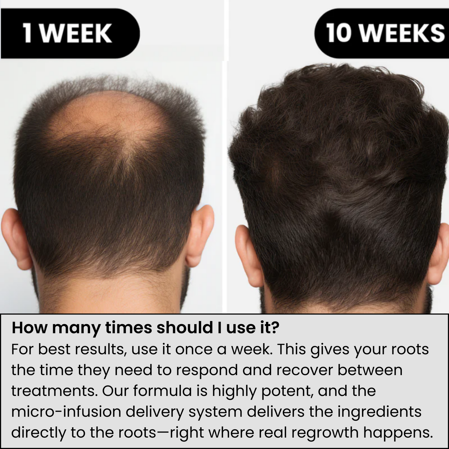 Ascendrtop™ Hair Regrowth System