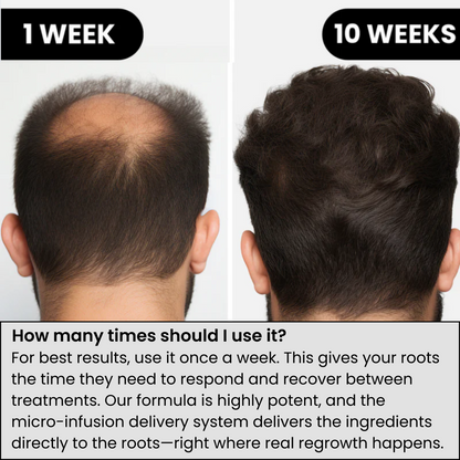 Ascendrtop™ Hair Regrowth System